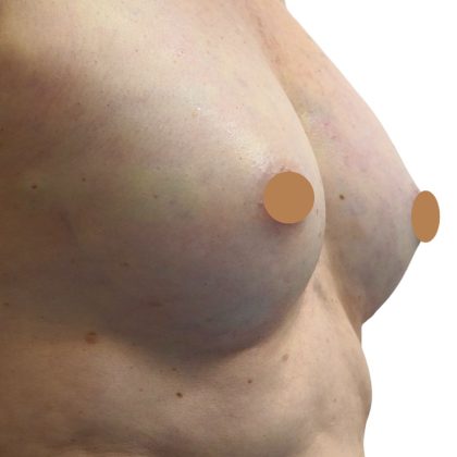 Breast Augmentation Before & After Patient #360