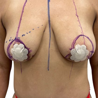 Breast Augmentation Before & After Patient #354