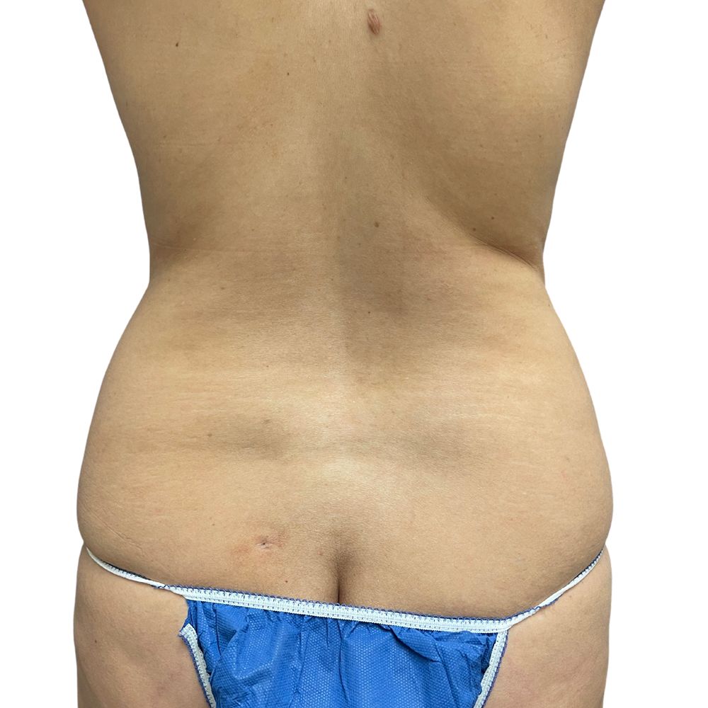 Love Handles Before & After Patient #236