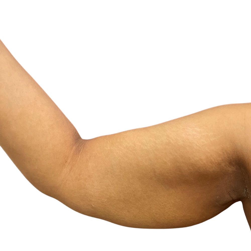 High Definition Arms Before & After Patient #381