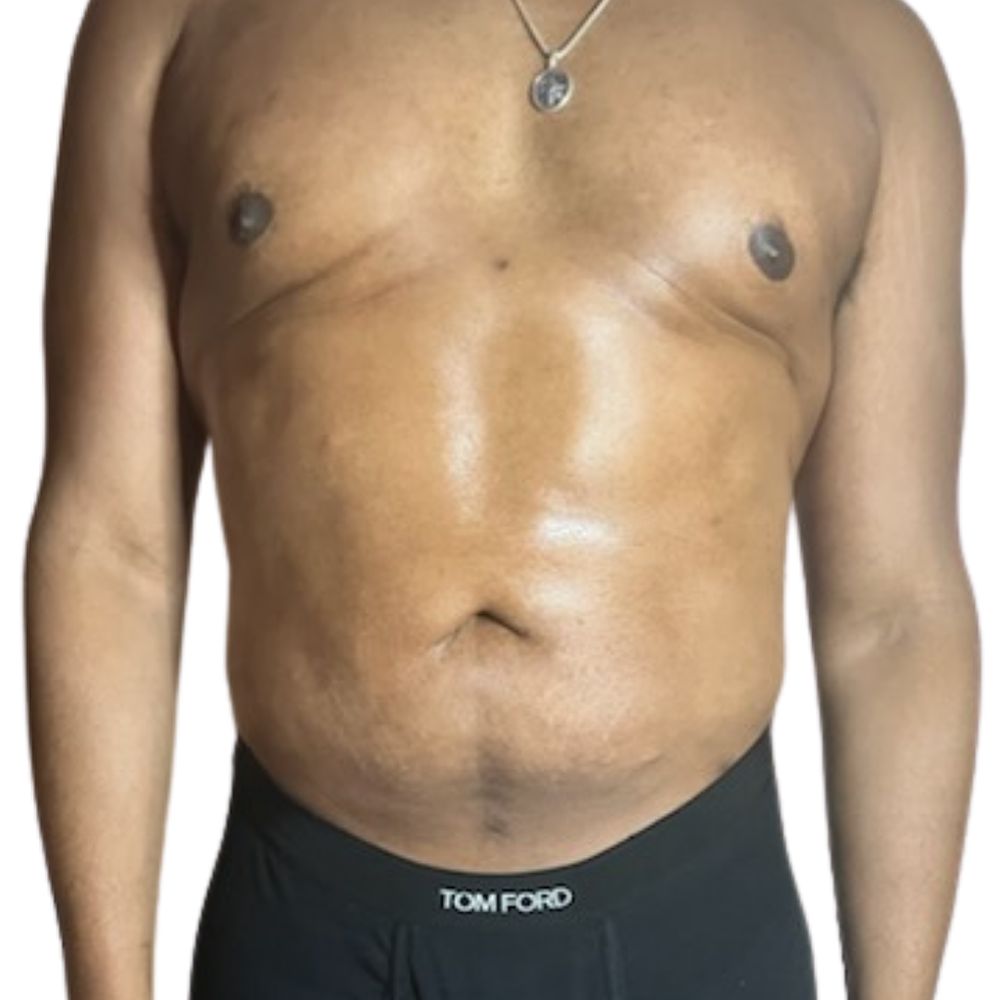 Abdominal Before & After Patient #240