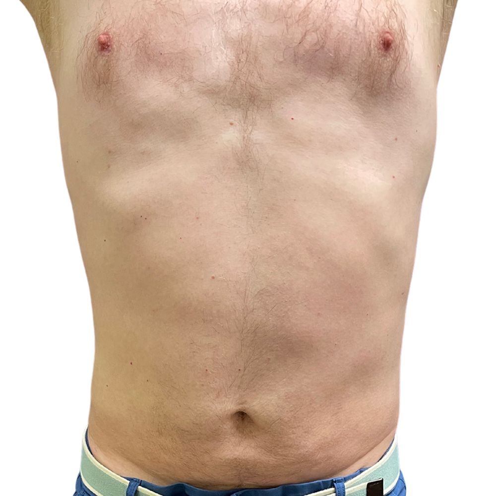 Abdominal Before & After Patient #246