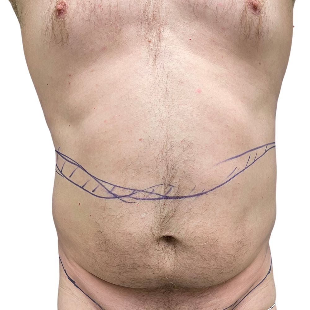 Abdominal Before & After Patient #246