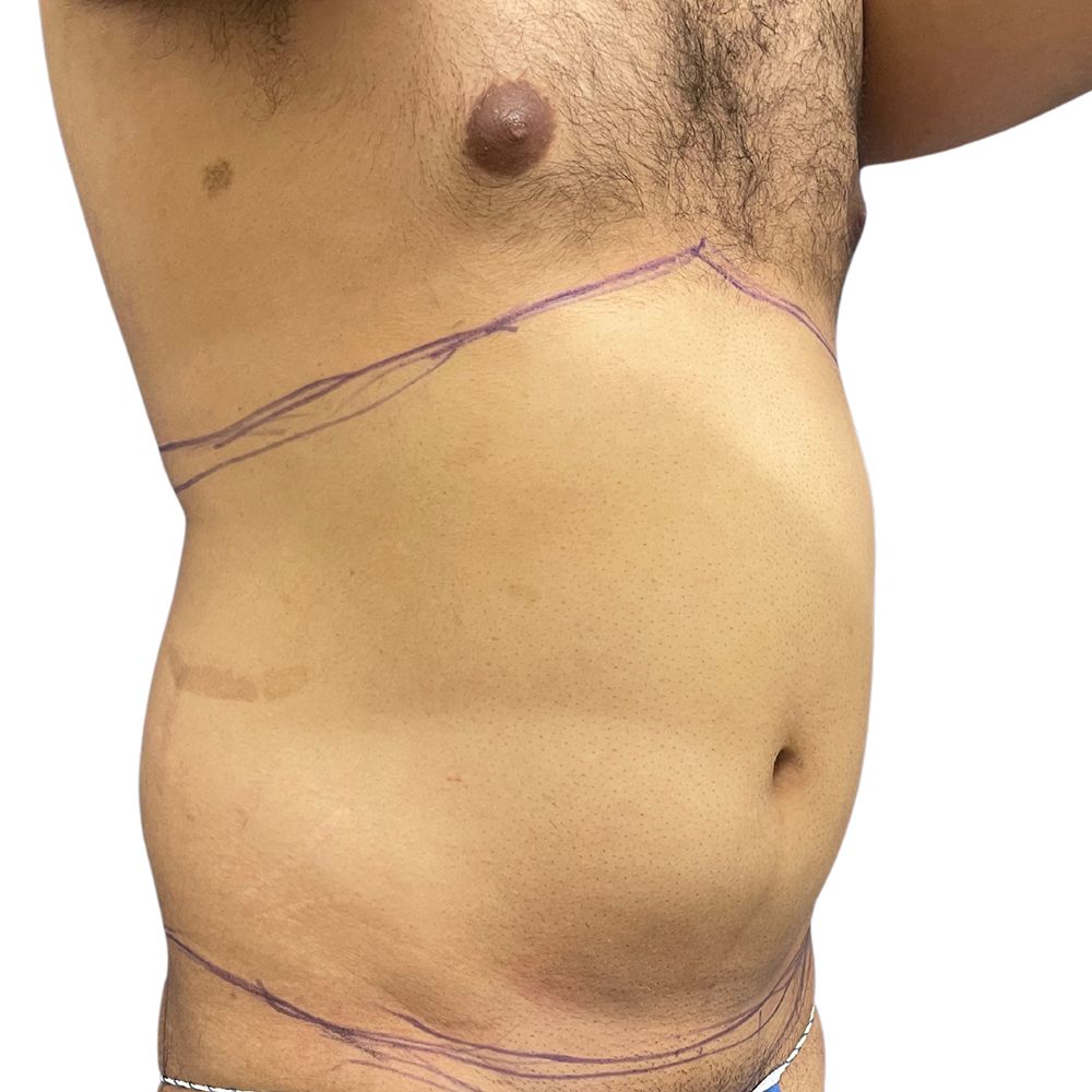 Abdominal Before & After Patient #251