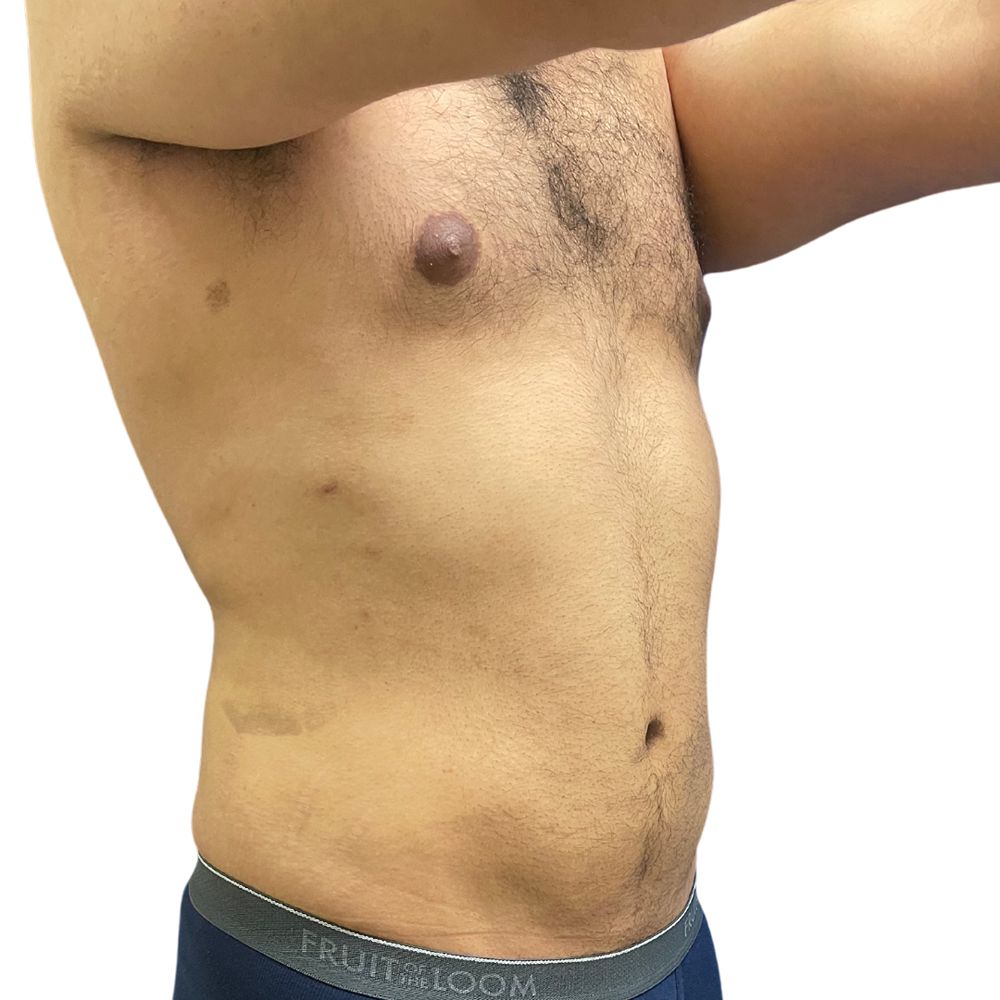 Abdominal Before & After Patient #251