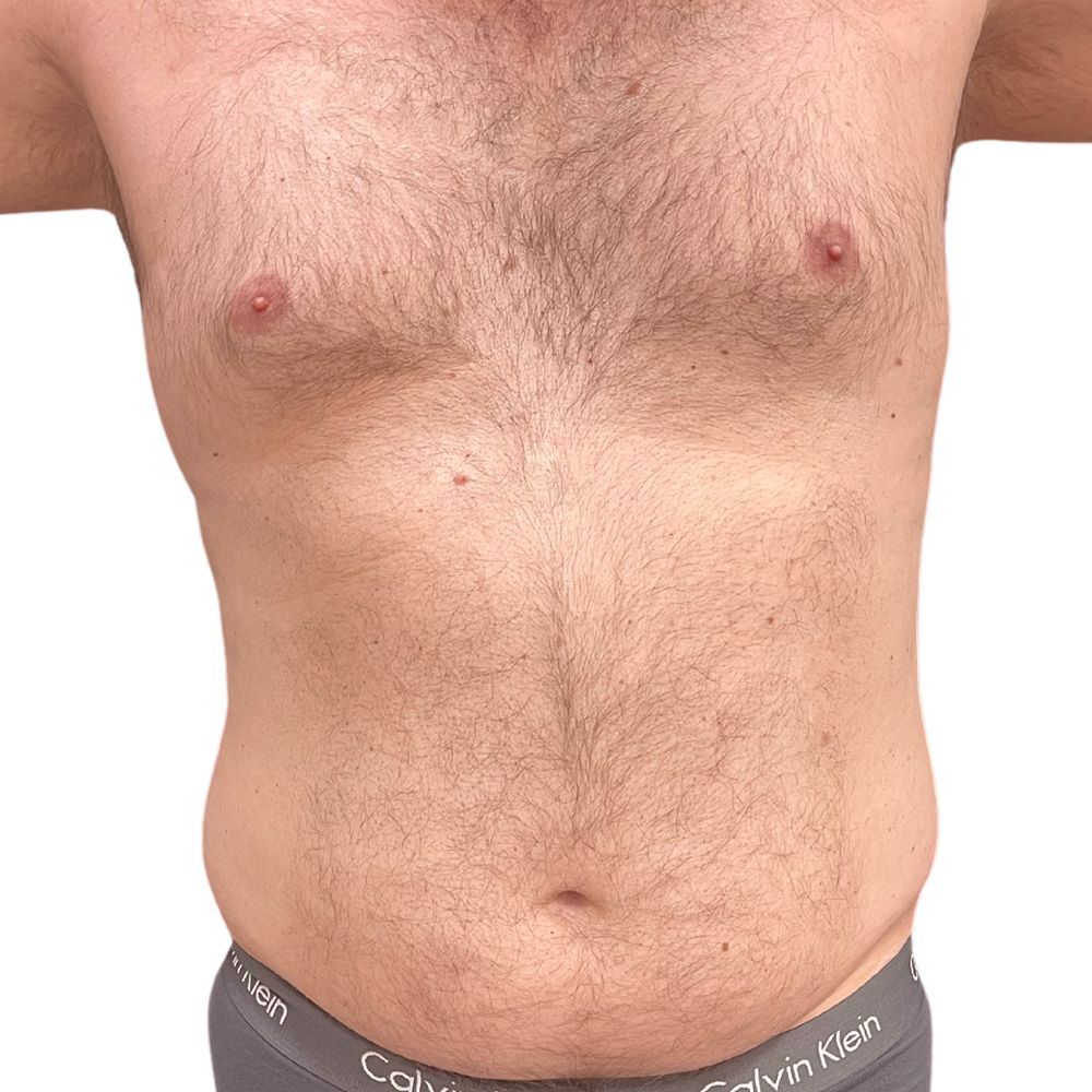 Abdominal Before & After Patient #254