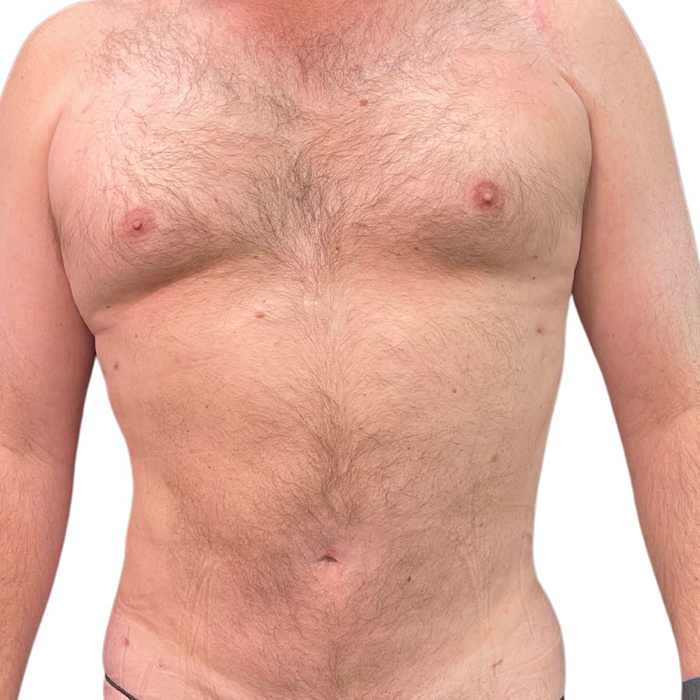 Abdominal Before & After Patient #254