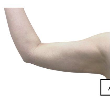 High Definition Arms Before & After Patient #370