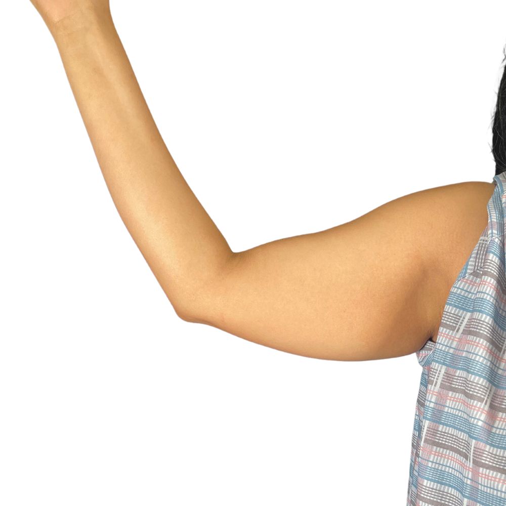 High Definition Arms Before & After Patient #378