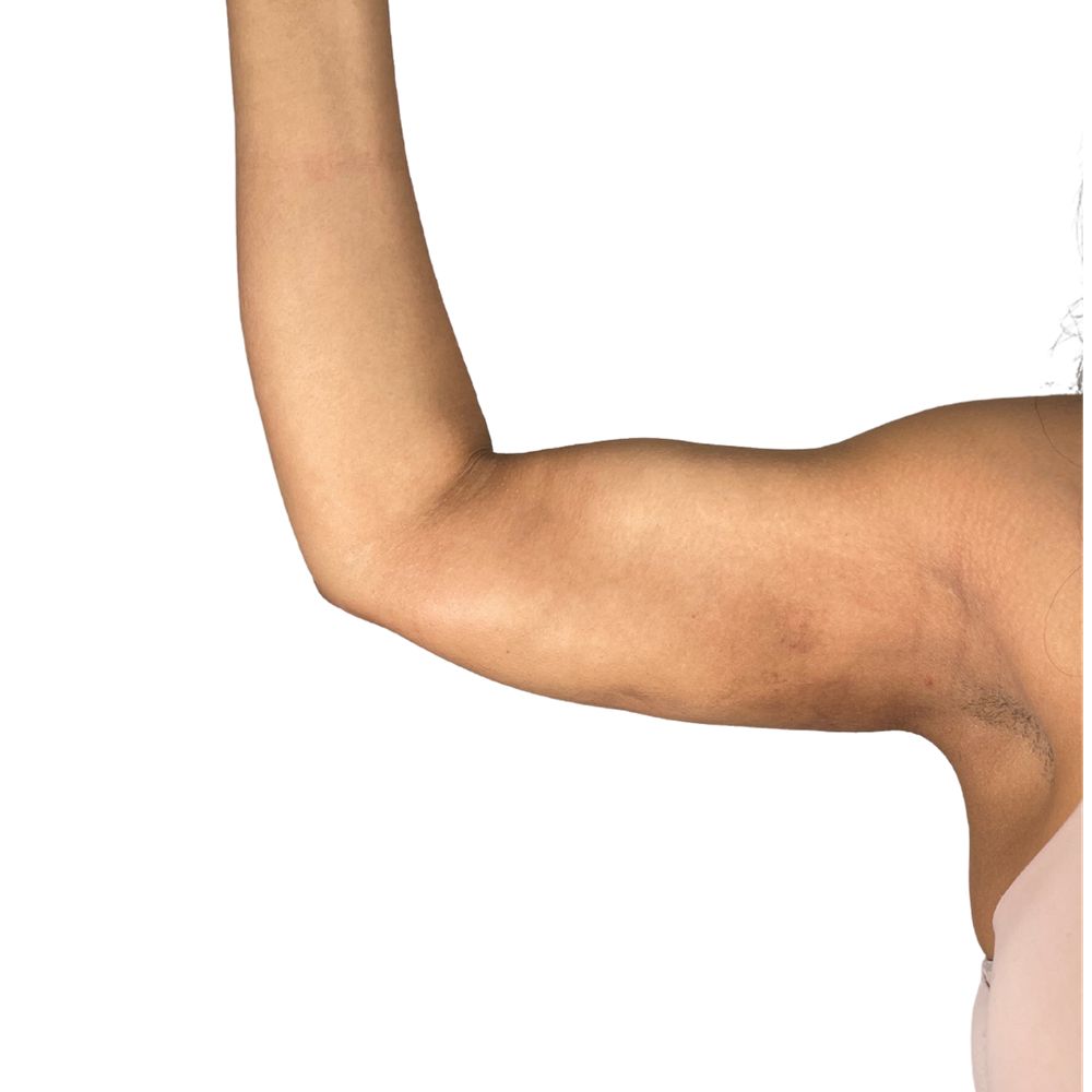 High Definition Arms Before & After Patient #378