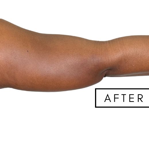 High Definition Arms Before & After Patient #363