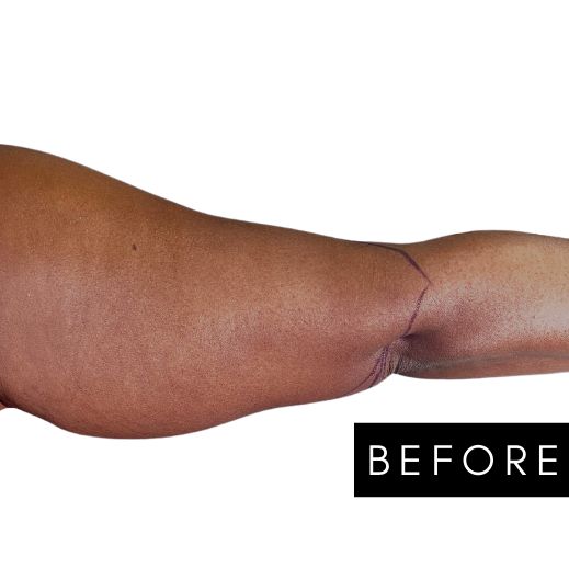 High Definition Arms Before & After Patient #363