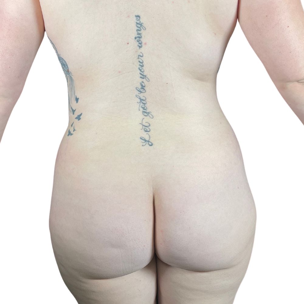 Brazilian Butt Lift Before & After Patient #145