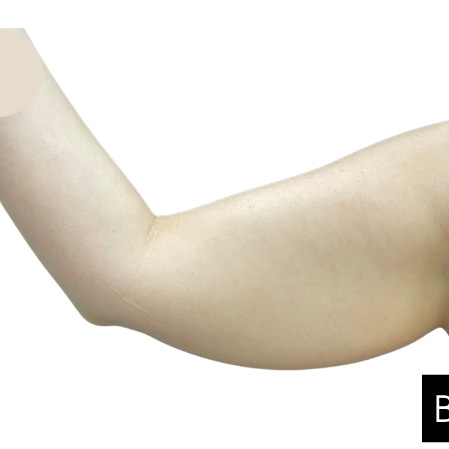 High Definition Arms Before & After Patient #370