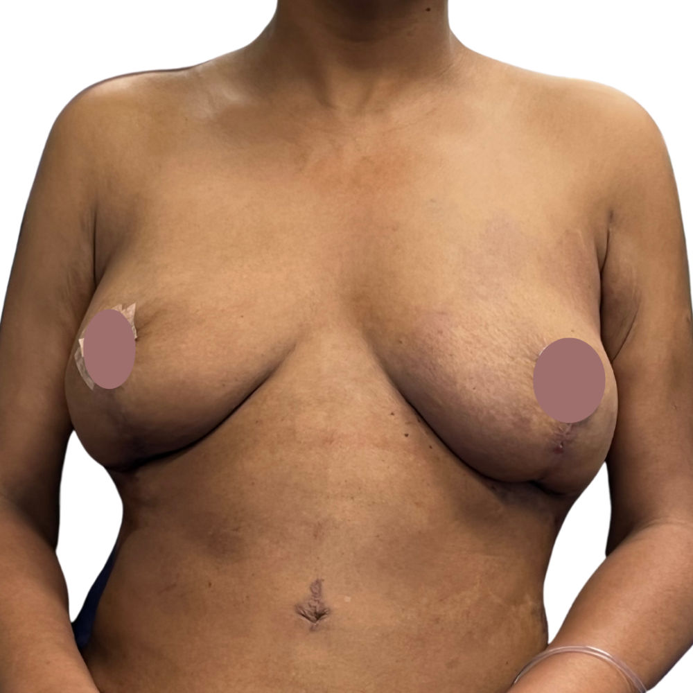 Breast Lift Before & After Patient #133