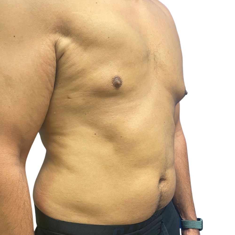 Gynecomastia Before & After Patient #206