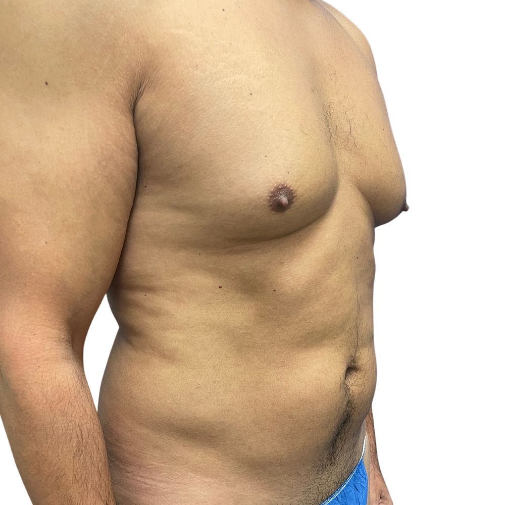 Gynecomastia Before & After Patient #206