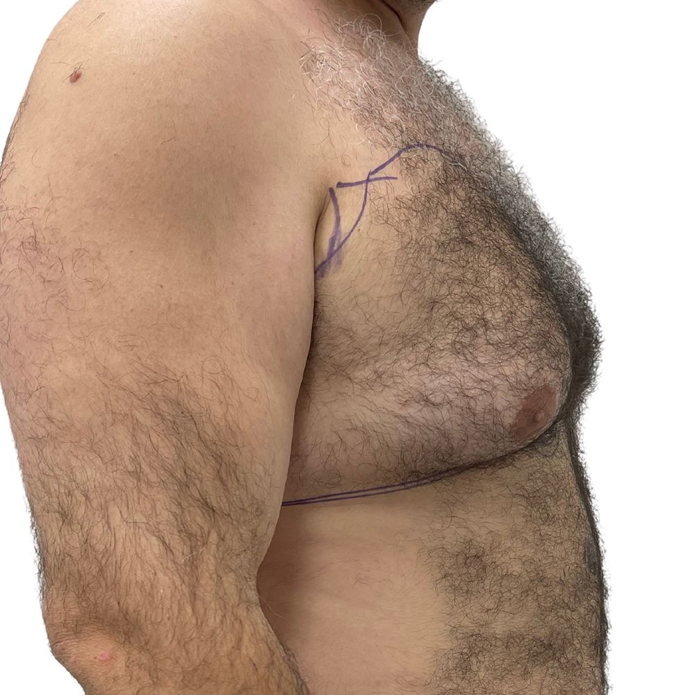 Gynecomastia Before & After Patient #223