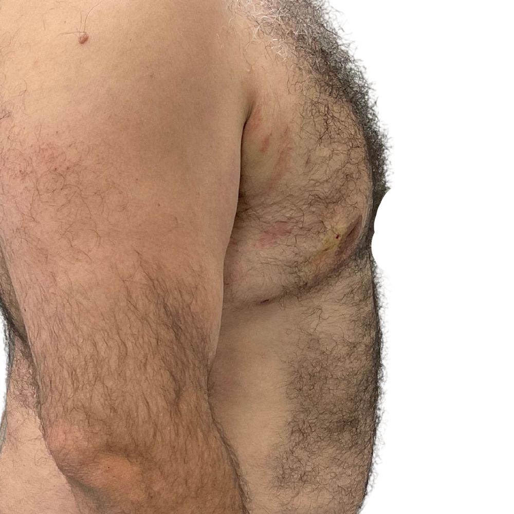 Gynecomastia Before & After Patient #223