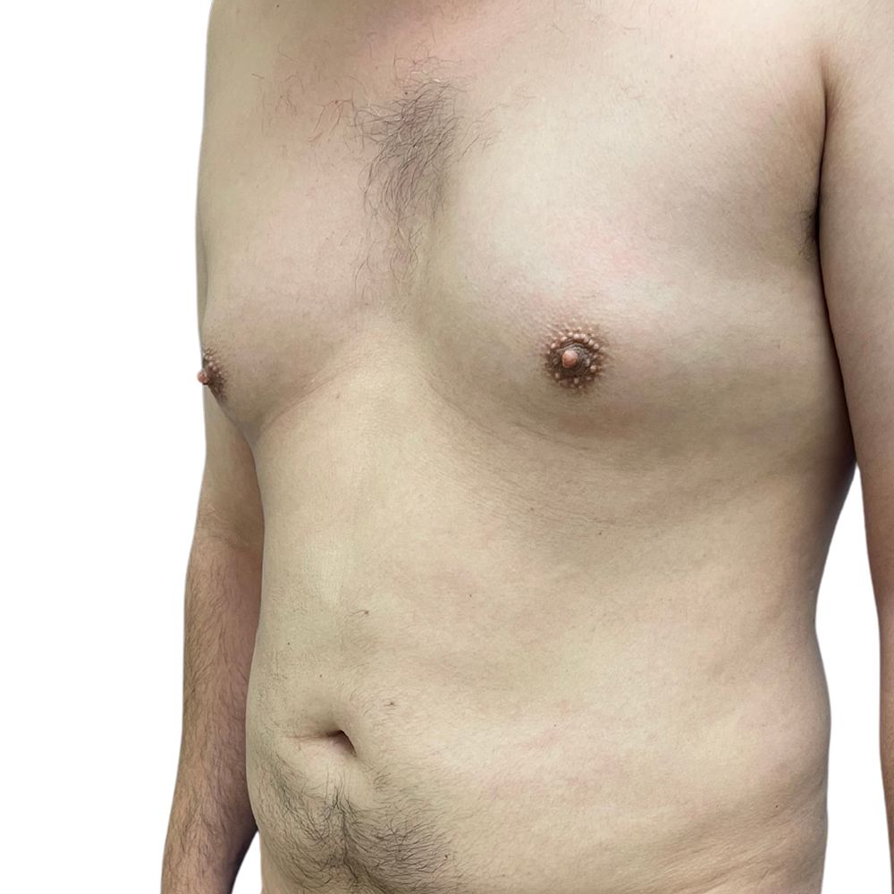 Gynecomastia Before & After Patient #227