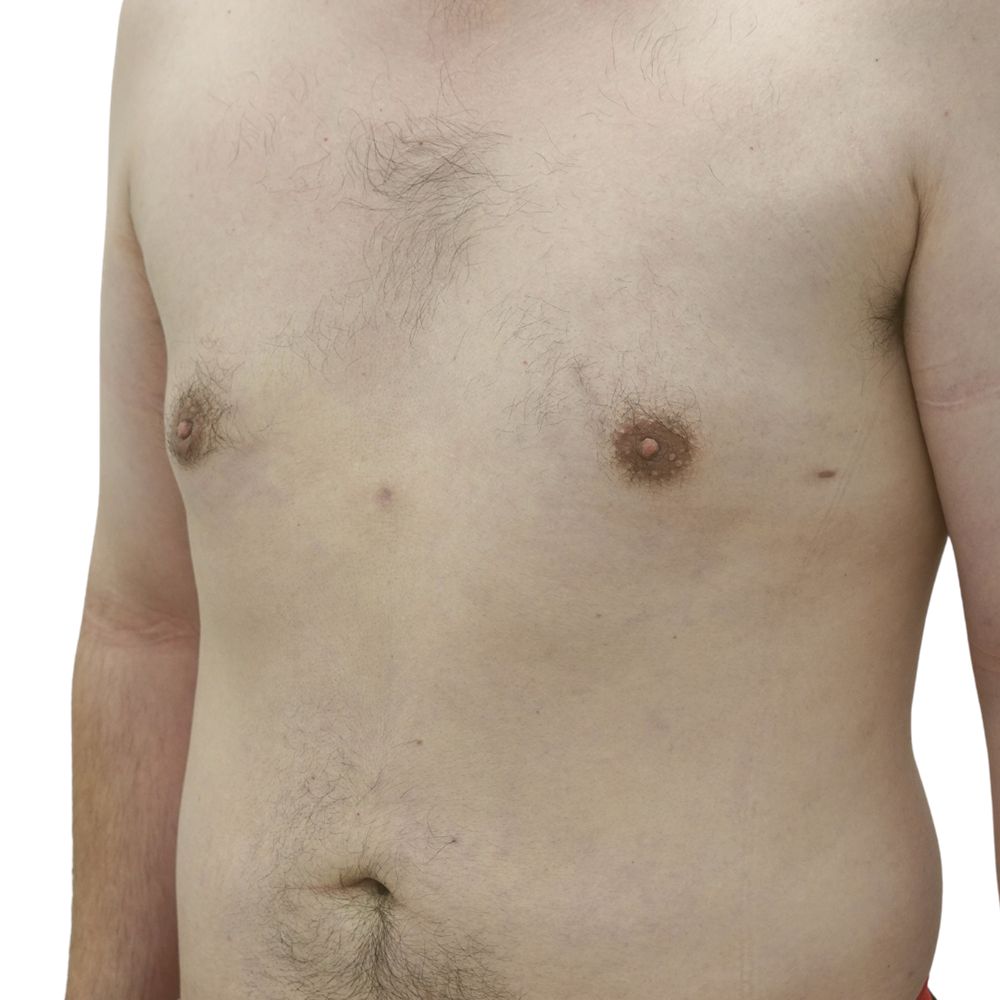 Gynecomastia Before & After Patient #227