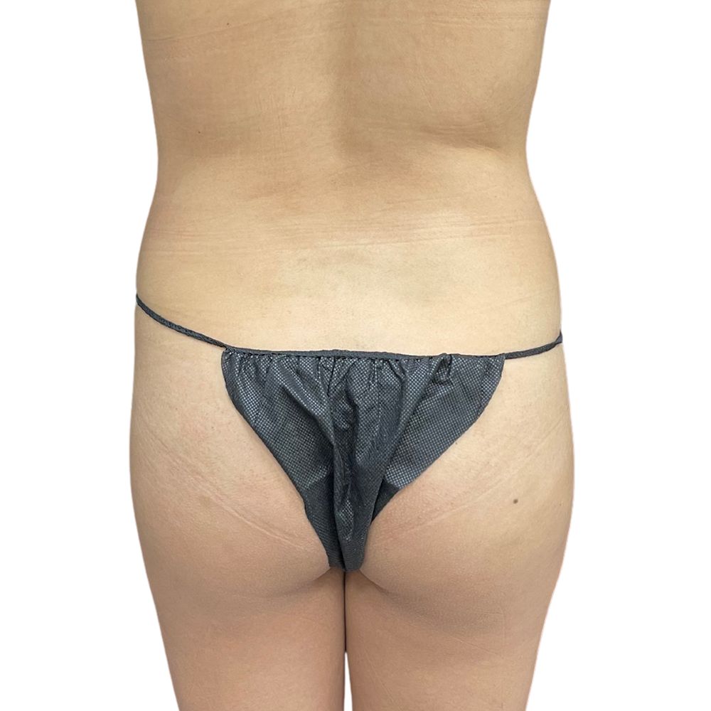 Brazilian Butt Lift Before & After Patient #186