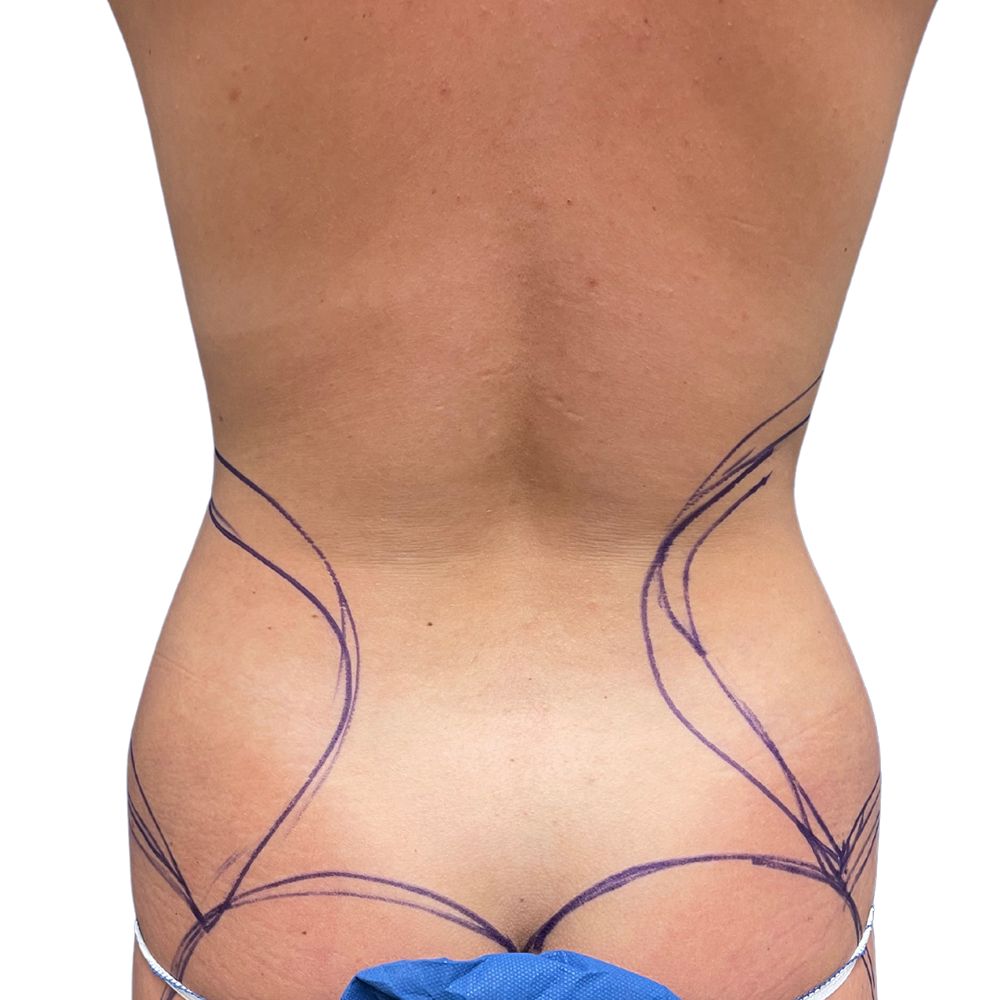 Love Handles Before & After Patient #230