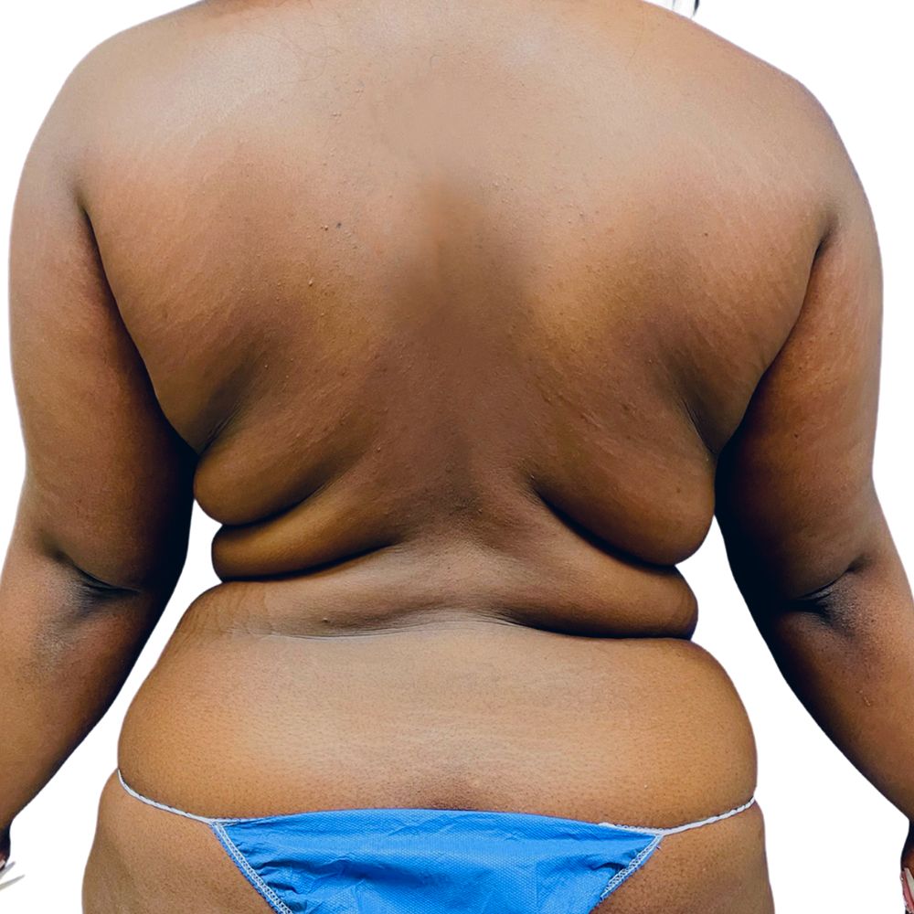 Love Handles Before & After Patient #233