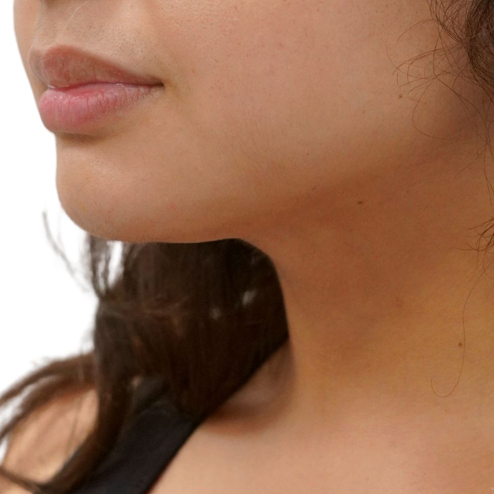 Neck & Jowls Before & After Patient #266