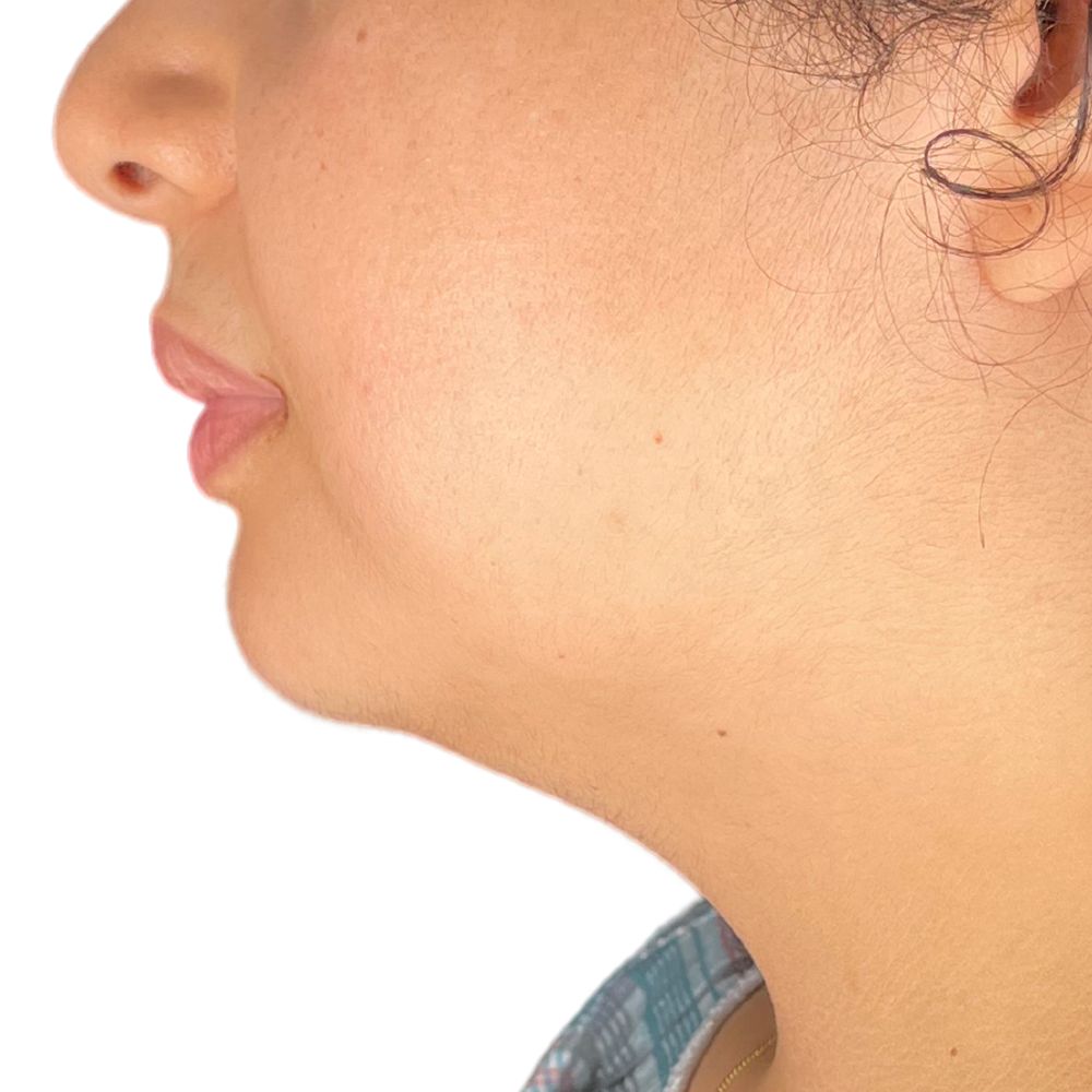 Neck & Jowls Before & After Patient #266