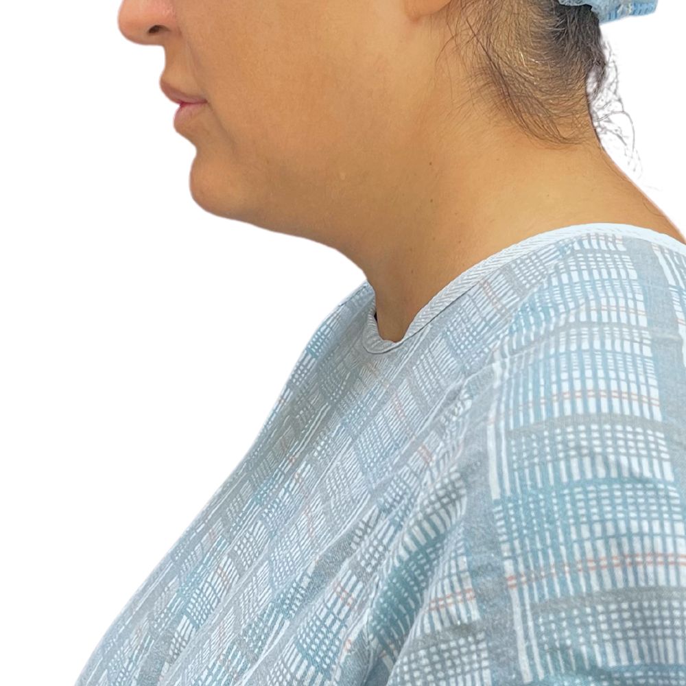 Neck & Jowls Before & After Patient #305