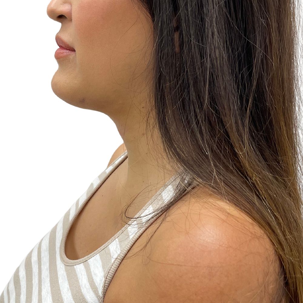 Neck & Jowls Before & After Patient #305