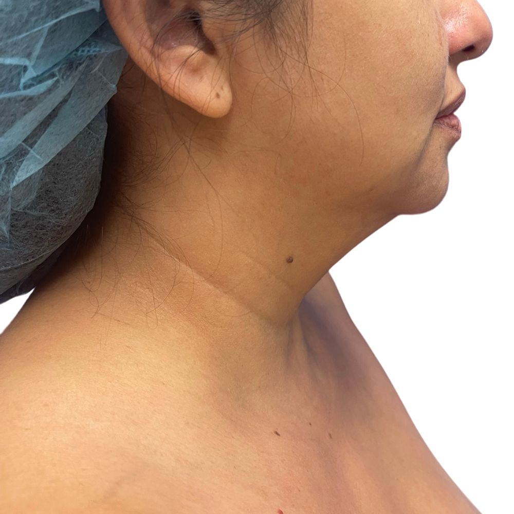 Neck & Jowls Before & After Patient #273