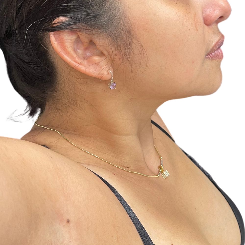 Neck & Jowls Before & After Patient #273