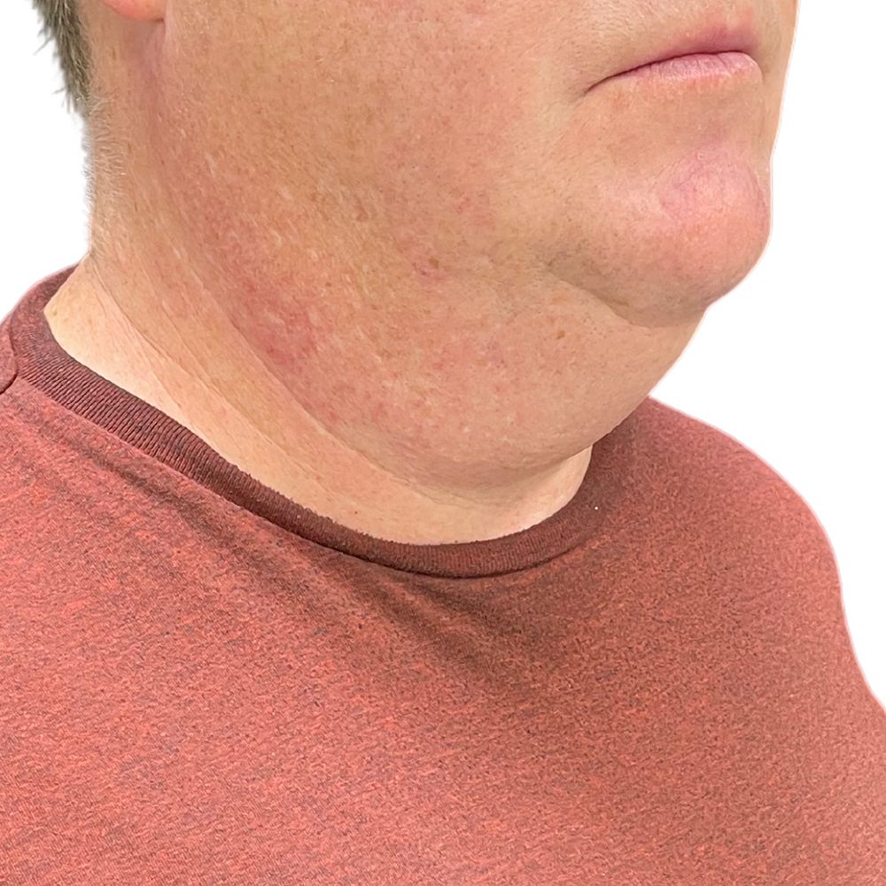 Neck Lift Before & After Patient #276