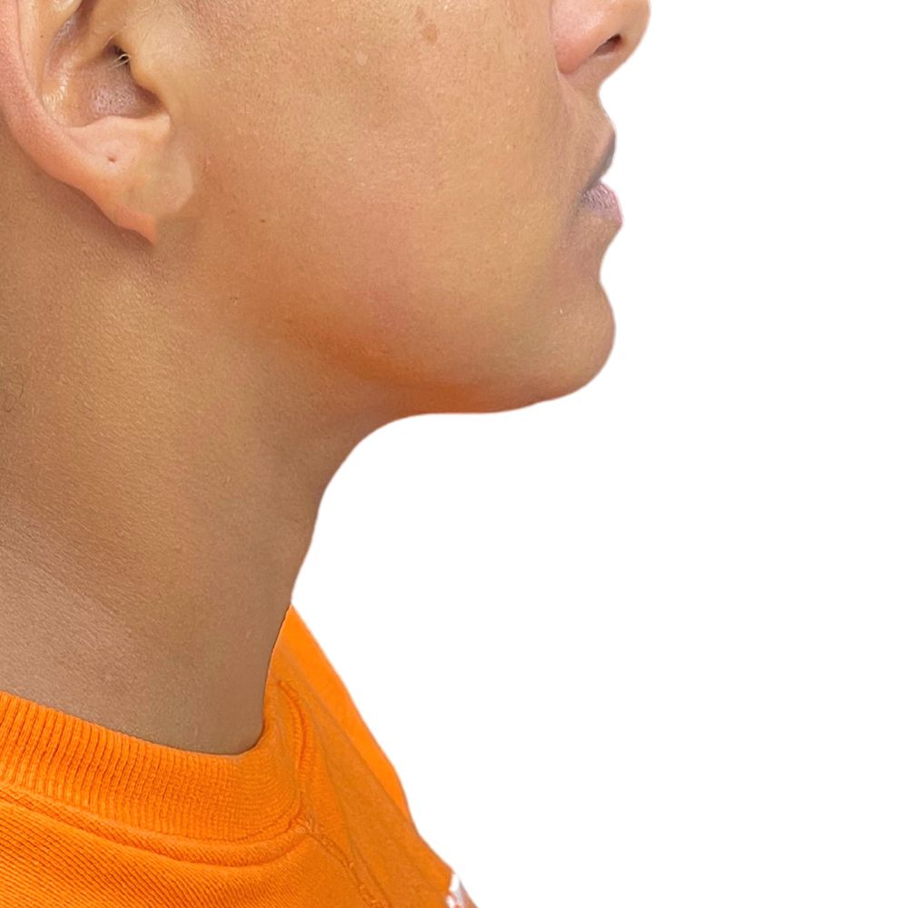 Neck & Jowls Before & After Patient #285