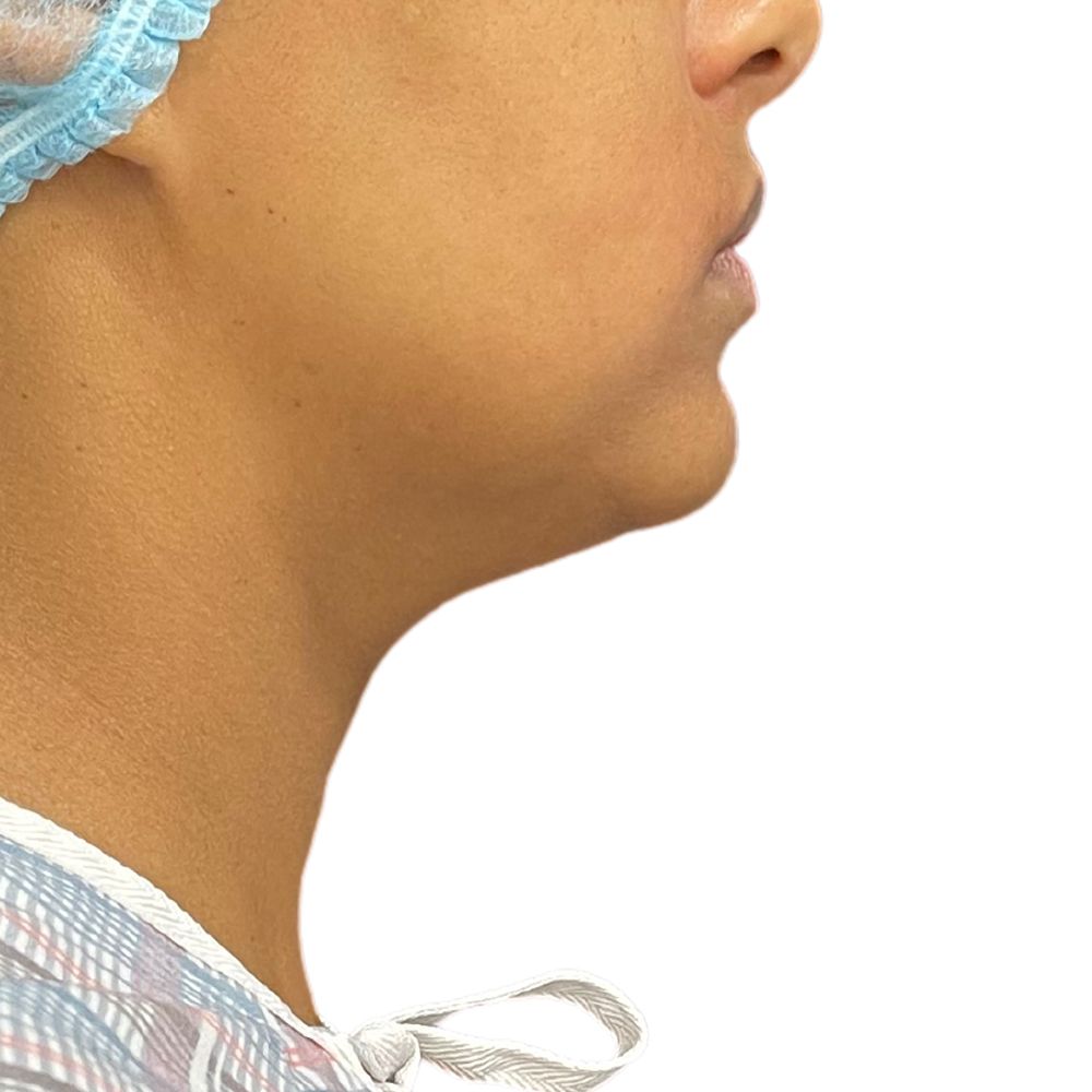 Neck & Jowls Before & After Patient #285