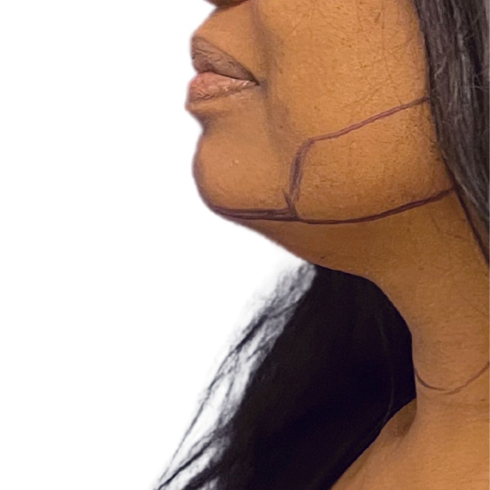 Neck & Jowls Before & After Patient #294