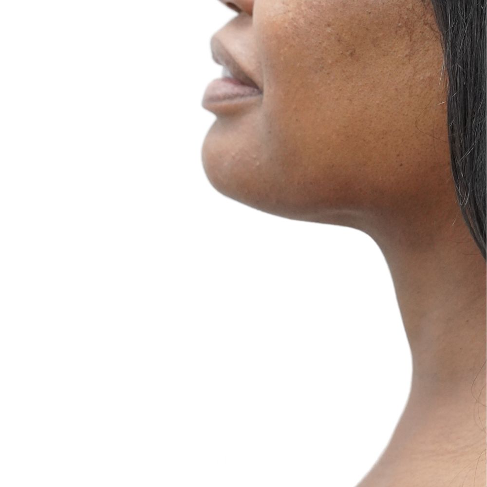 Neck & Jowls Before & After Patient #294