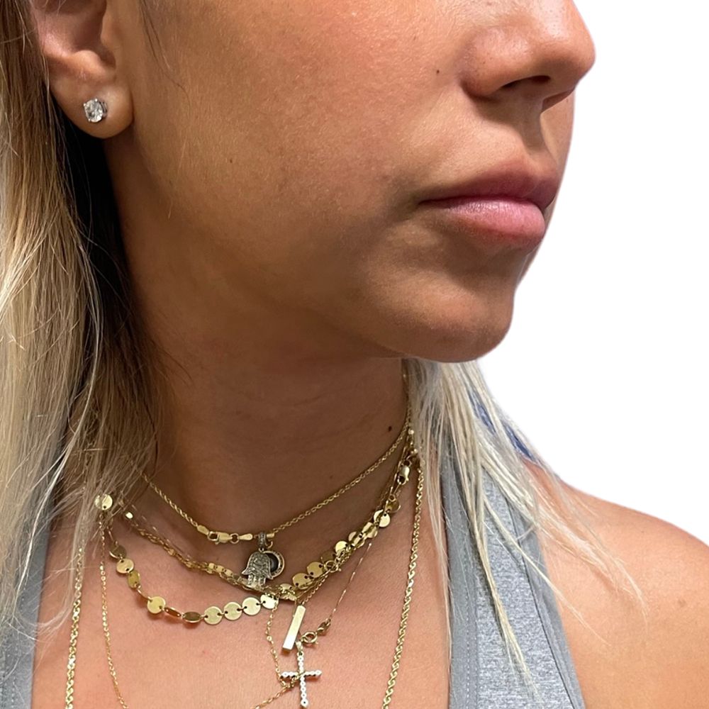 Neck & Jowls Before & After Patient #302