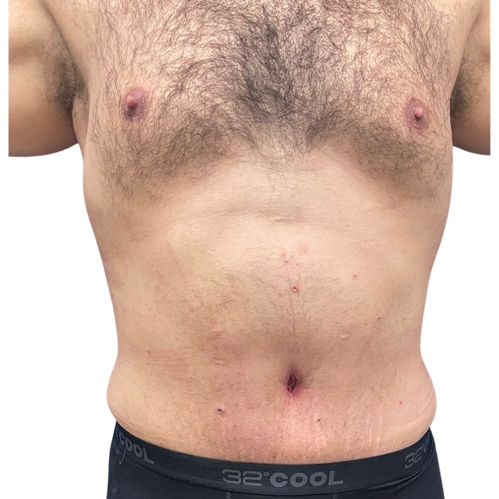 Tummy Tuck Before & After Patient #308