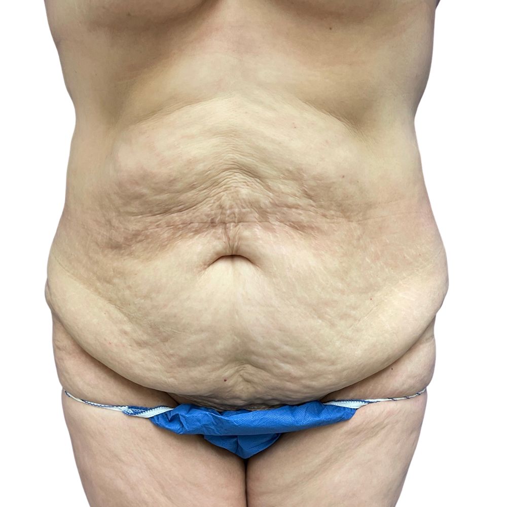 Tummy Tuck Before & After Patient #342
