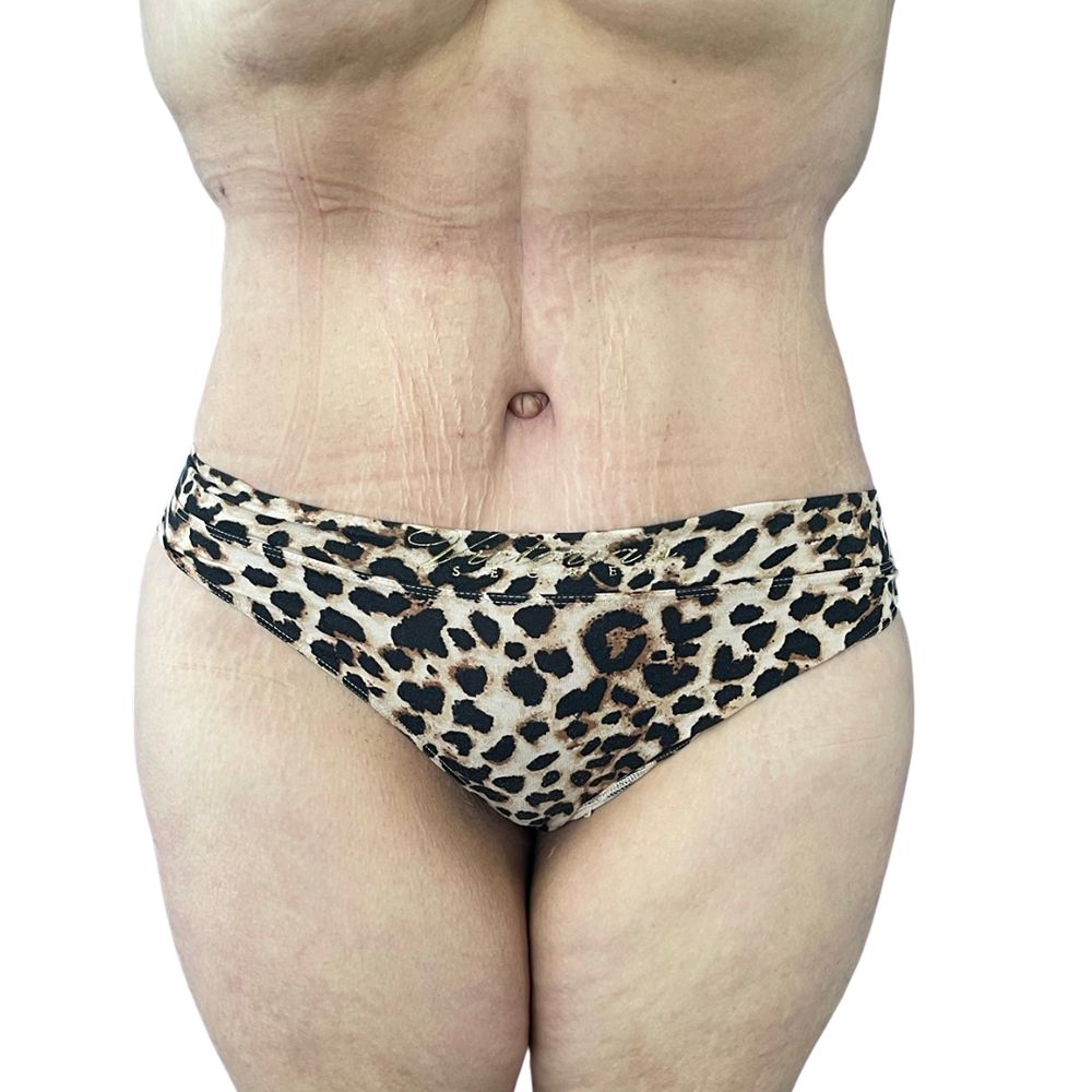 Tummy Tuck Before & After Patient #342