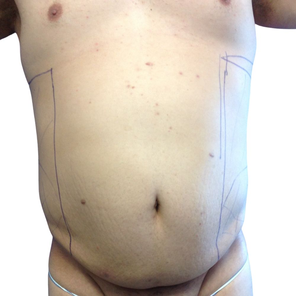 Tummy Tuck Before & After Patient #345