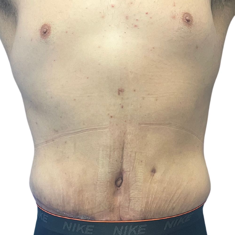 Tummy Tuck Before & After Patient #345