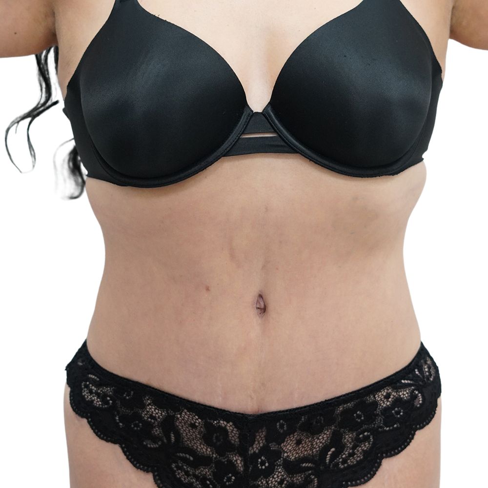 Tummy Tuck Before & After Patient #348