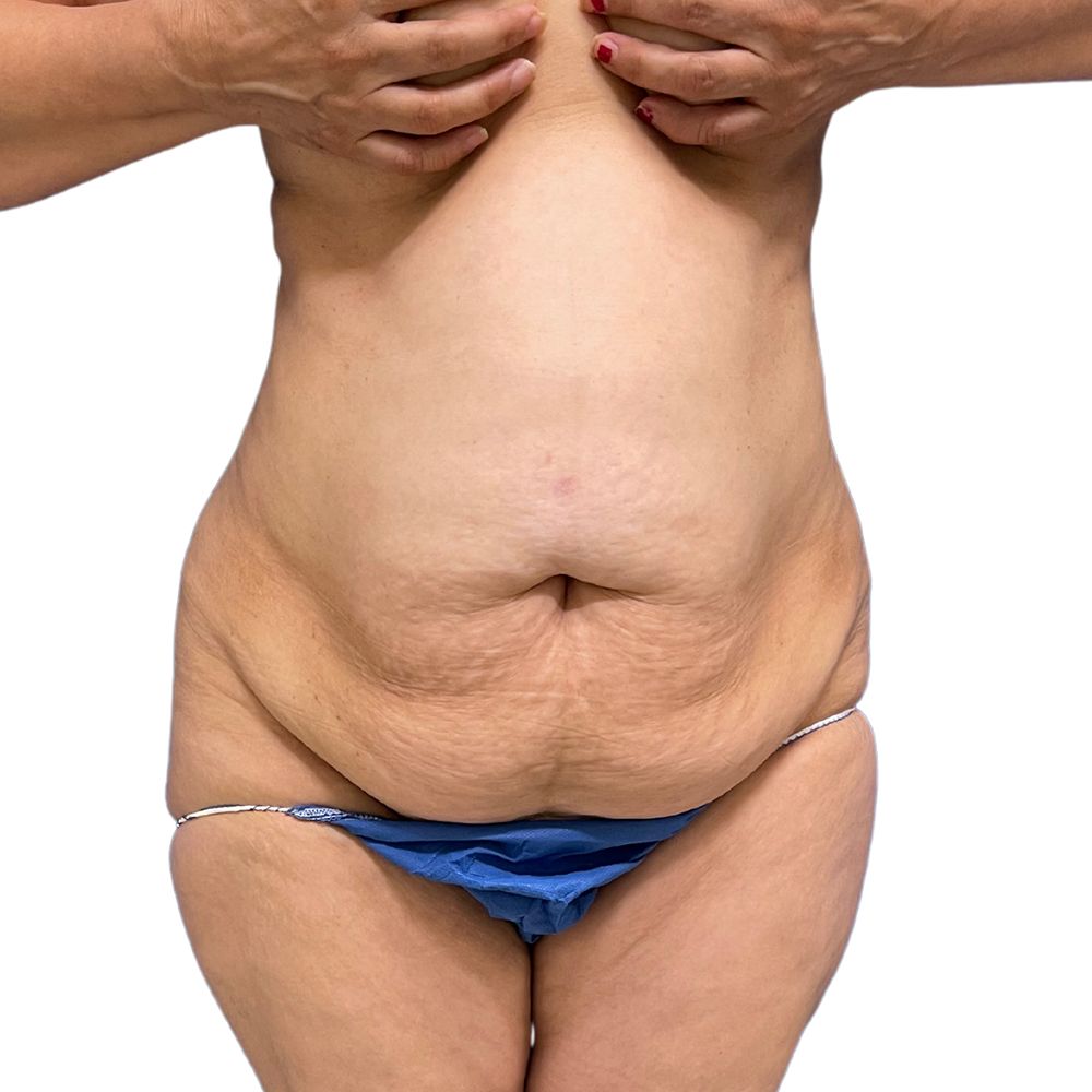 Tummy Tuck Before & After Patient #351