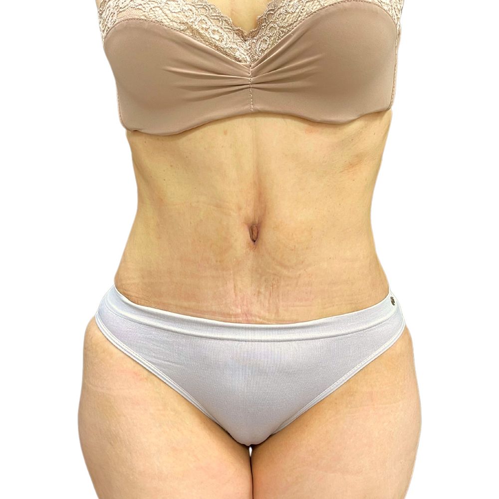 Tummy Tuck Before & After Patient #351