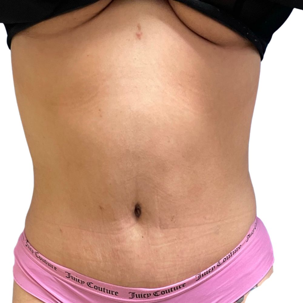 Tummy Tuck Before & After Patient #311