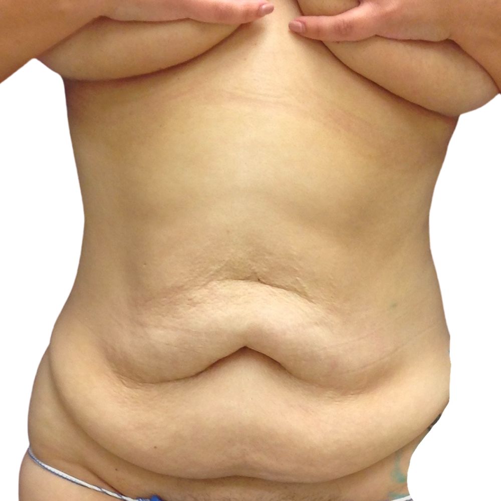 Tummy Tuck Before & After Patient #311